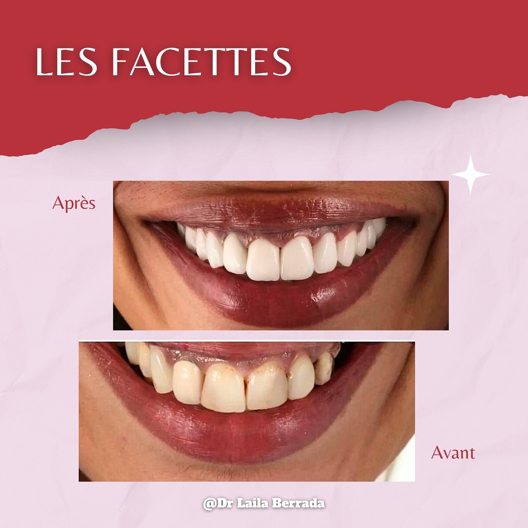 Transformation de sourire - Cas 1